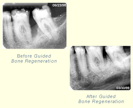 Before and after Guided Bone Regeneration