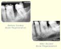 Before and after Guided Bone Regeneration thumbnail