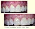 Gingival Grafting of Multiple Upper Front Teeth
