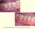 Gingival grafting of the lower right posterior