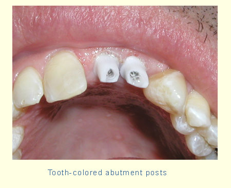Tooth-colored abutment posts