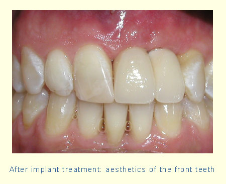 After implant treatment: aesthetics of the front teeth