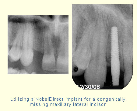 Utilizing a NobelDirect implant for a congenitally missing maxillary lateral incisor