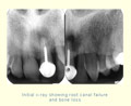 Initial x-ray showing root canal failure and bone loss