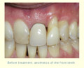 Before treatment: aesthetics of the front teeth