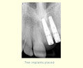 Two implants placed