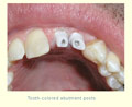 Tooth-colored abutment posts