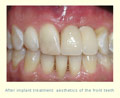 After implant treatment: easthetics of the front teeth