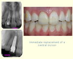 Immediate replacement of a central incisor