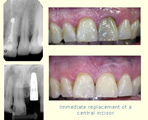 Immediate replacement of a central incisor