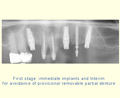 First stage: immediate implants and Interim implant for avoidance of provisional removable partial denture