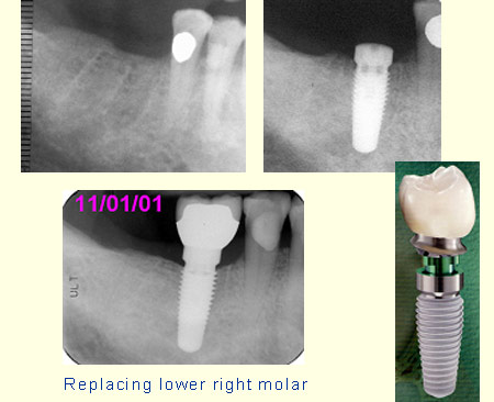 Replacing lower right molar