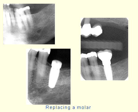 Replacing a molar