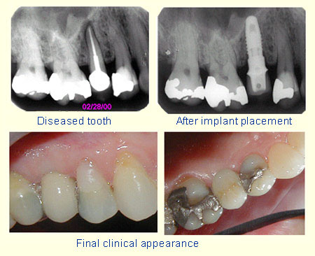Diseased tooth, After implant placement and Final clinical appearance