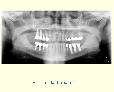 After implant treatment