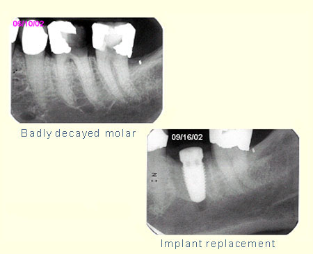 Badly decayed molar, Implant replacement