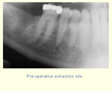 Pre-operative extraction site