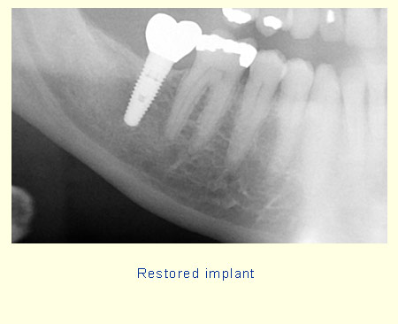 Restored implant