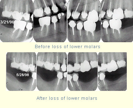 Before and after loss of lower molars