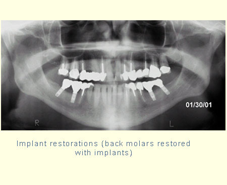 Implant restorations (back molars restored with implants)