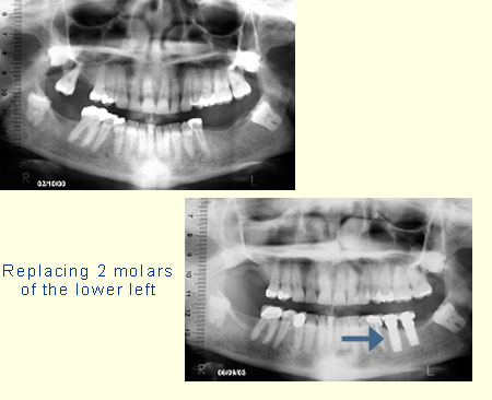 Replacint 2 molars of the lower left