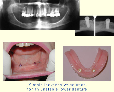 Simple inexpensive solution for an unstable lower denture