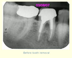 Before tooth removal