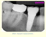 After implant replacement