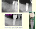 Replacing a lower 1st molar thumbnail