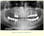 Before implant treatment