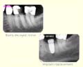 Replacing a hopless molar slide one thumbnail