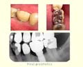 Replacing a hopeless molar slide 2 thumbnail