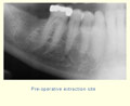 Replacing a 2nd molar slide 1 thumbnail