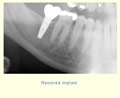 Replacing a 2nd molar slide 2 thumbnail