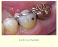 Replacing a 2nd molar slide 3 thumbnail
