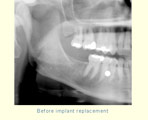 Before implant replacement