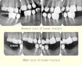 Replacing missing lower molar teeth slide 1 thumbnail