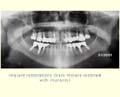 Replacing missing lower molar teeth slide 2 thumbnail