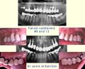Upper molar implants over 9 years in function thumbnail