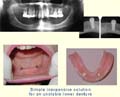 Stabilizing a lower left denture thumbnail