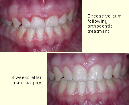 Excessive gum following orthodontic treatment and after surgery