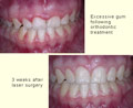 Excessive gum following orthodontic treatment