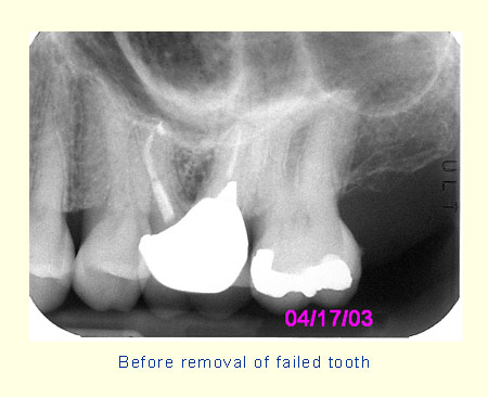 Before removal of failed tooth