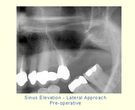 Sinus Elevation - Lateral Approach Pre-operative