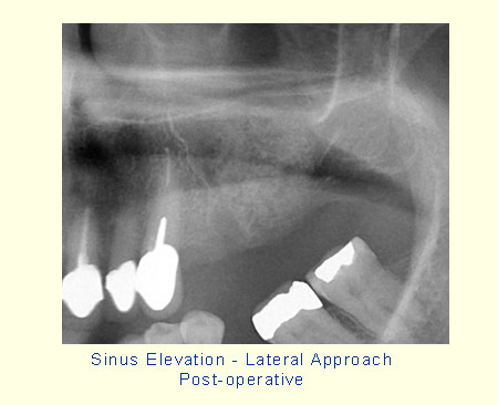 Sinus Elevation - Lateral Approach Post-operative