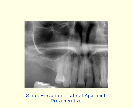 Sinus Elevation - Lateral Approach - Pre-operative
