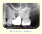 Before removal of failed tooth