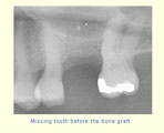 Missing toothe before the bone graft