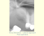Sinus Elevation - Lateral Approach - Post-operative