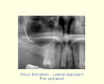 Sinus Elevation - Lateral Approach